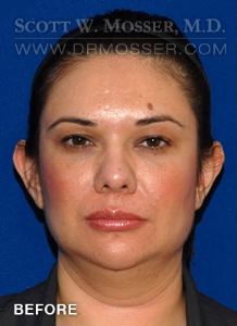 Liposuction - Face Patient 78389 Before Photo # 1