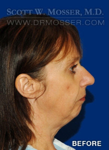 Rhinoplasty Patient 80799 Before Photo # 1