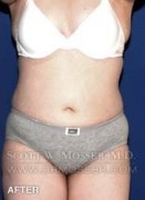 Liposuction - Abdomen & Flanks Patient 26351 After Photo Thumbnail # 2