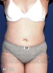 Liposuction - Abdomen & Flanks Patient 26351 After Photo # 2