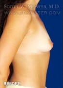 Breast Augmentation Patient 70508 Before Photo Thumbnail # 5