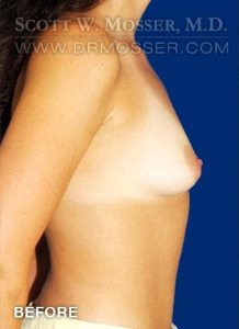 Breast Augmentation Patient 70508 Before Photo # 5