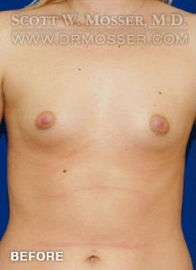 Breast Augmentation Patient 61622 Before Photo # 1