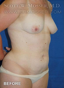 Abdominoplasty Patient 98672 Before Photo # 3