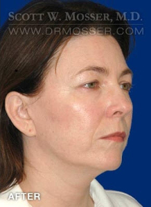 Chin Implant Patient 16572 After Photo # 8