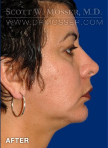 Chin Implant Patient 68063 After Photo # 6