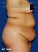 Liposuction - Abdomen & Flanks Patient 51266 Before Photo Thumbnail # 3