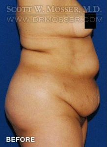 Liposuction - Abdomen & Flanks Patient 51266 Before Photo # 3