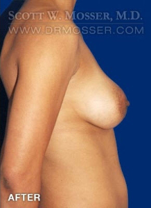 Breast Augmentation Patient 83067 After Photo # 6
