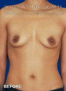 Breast Augmentation Patient 83067 Before Photo # 1