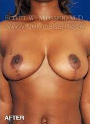 Breast Lift Without Implants Patient 95927 After Photo # 2