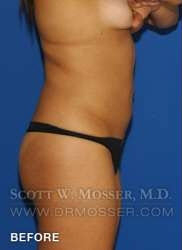 Liposuction - Abdomen & Flanks Patient 33709 Before Photo # 7