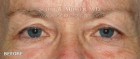 Upper Blepharoplasty Patient 93893 Before Photo Thumbnail # 1