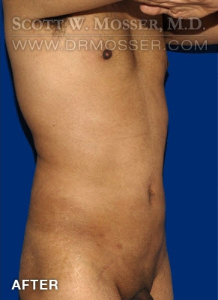 Liposuction - Abdomen & Flanks Patient 52450 After Photo # 4