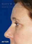Lower Blepharoplasty Patient 38290 After Photo Thumbnail # 4