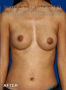 Breast Augmentation Patient 68907 After Photo # 2