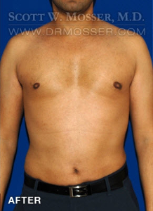 Liposuction - Chest Patient 51091 After Photo # 2