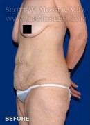 Lower Body Lift Patient 68424 Before Photo Thumbnail # 5