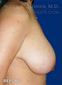 Breast Reduction Patient 54903 Before Photo # 3