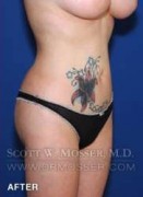 Liposuction - Abdomen & Flanks Patient 81638 After Photo Thumbnail # 4