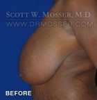 Breast Reduction Patient 70589 Before Photo Thumbnail # 5