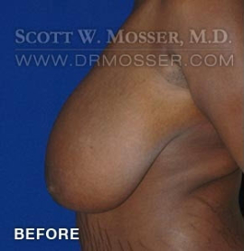 Breast Reduction Patient 70589 Before Photo # 5