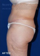 Abdominoplasty Patient 61872 After Photo Thumbnail # 4