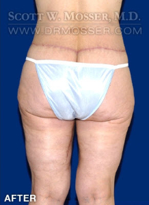 Thigh Lift Patient 28030 After Photo # 4