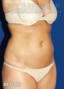 Liposuction - Abdomen & Flanks Patient 39576 Before Photo Thumbnail # 5