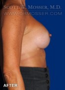 Breast Augmentation Patient 52419 After Photo Thumbnail # 2