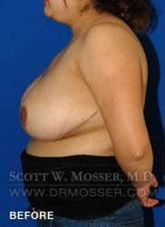 Breast Reduction Patient 27332 Before Photo # 7