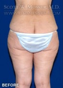 Thigh Lift Patient 28030 Before Photo Thumbnail # 3