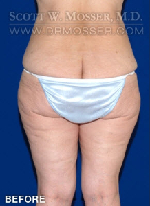 Thigh Lift Patient 28030 Before Photo # 3