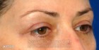 Lower Blepharoplasty Patient 88372 After Photo Thumbnail # 4