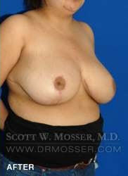 Breast Reduction Patient 27332 After Photo # 2