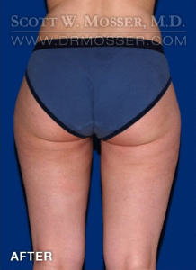 Liposuction - Thighs Patient 97167 After Photo # 4