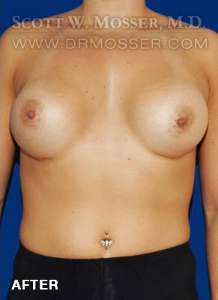Breast Augmentation Patient 13760 After Photo # 2