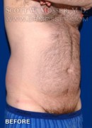Liposuction - Abdomen & Flanks Patient 23232 Before Photo Thumbnail # 3