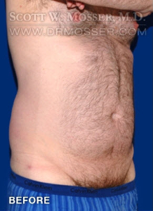 Liposuction - Abdomen & Flanks Patient 23232 Before Photo # 3