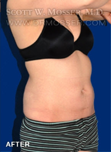 Liposuction - Abdomen & Flanks Patient 75438 After Photo # 6