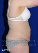 Liposuction - Abdomen & Flanks Patient 26351 After Photo Thumbnail # 6