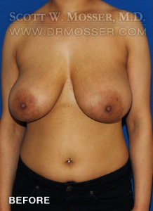 Breast Lift Without Implants Patient 97360 Before Photo # 1