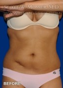 Liposuction - Abdomen & Flanks Patient 95887 Before Photo Thumbnail # 1