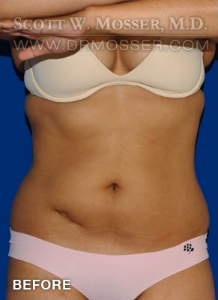 Liposuction - Abdomen & Flanks Patient 95887 Before Photo # 1