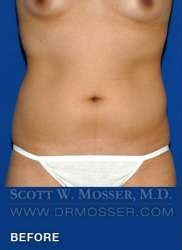 Liposuction - Abdomen & Flanks Patient 58519 Before Photo # 1