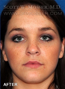 Liposuction - Face Patient 40198 After Photo # 2