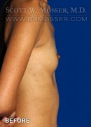 Breast Augmentation Patient 68907 Before Photo Thumbnail # 5