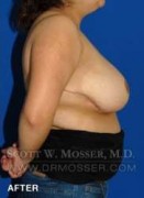 Breast Reduction Patient 27332 After Photo Thumbnail # 6