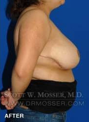 Breast Reduction Patient 27332 After Photo # 6