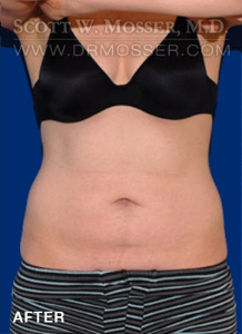Liposuction - Abdomen & Flanks Patient 75438 After Photo # 2